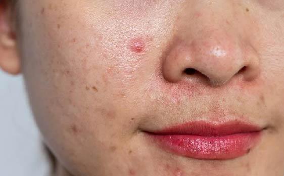 BioCare Acne & Oil Control Sunscreen Moisturizer SPF 60+