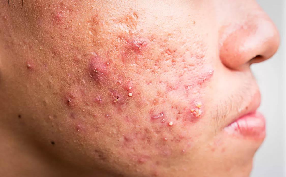 BioCare Acne, Oil & Pores Minimizing Serum