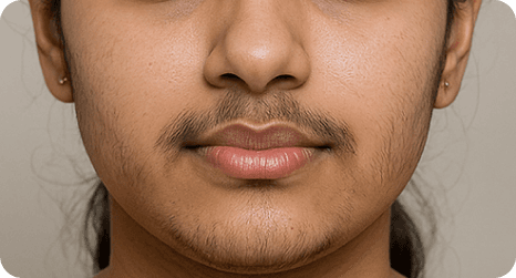 MESOSHR – Excess Hair Solution